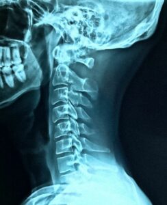 x ray of a persons neck
